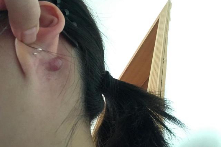 耳部表皮囊肿图