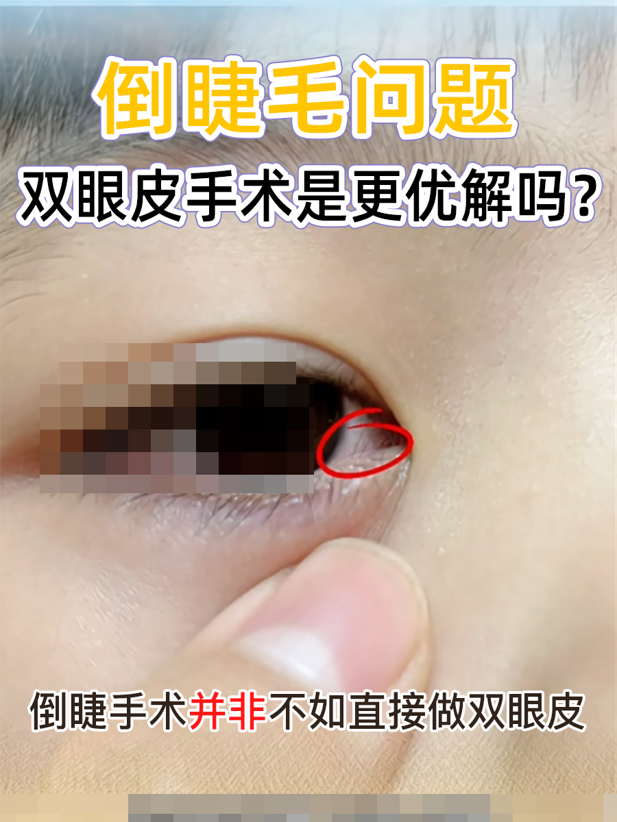 倒睫毛问题,双眼皮手术是更优解吗?