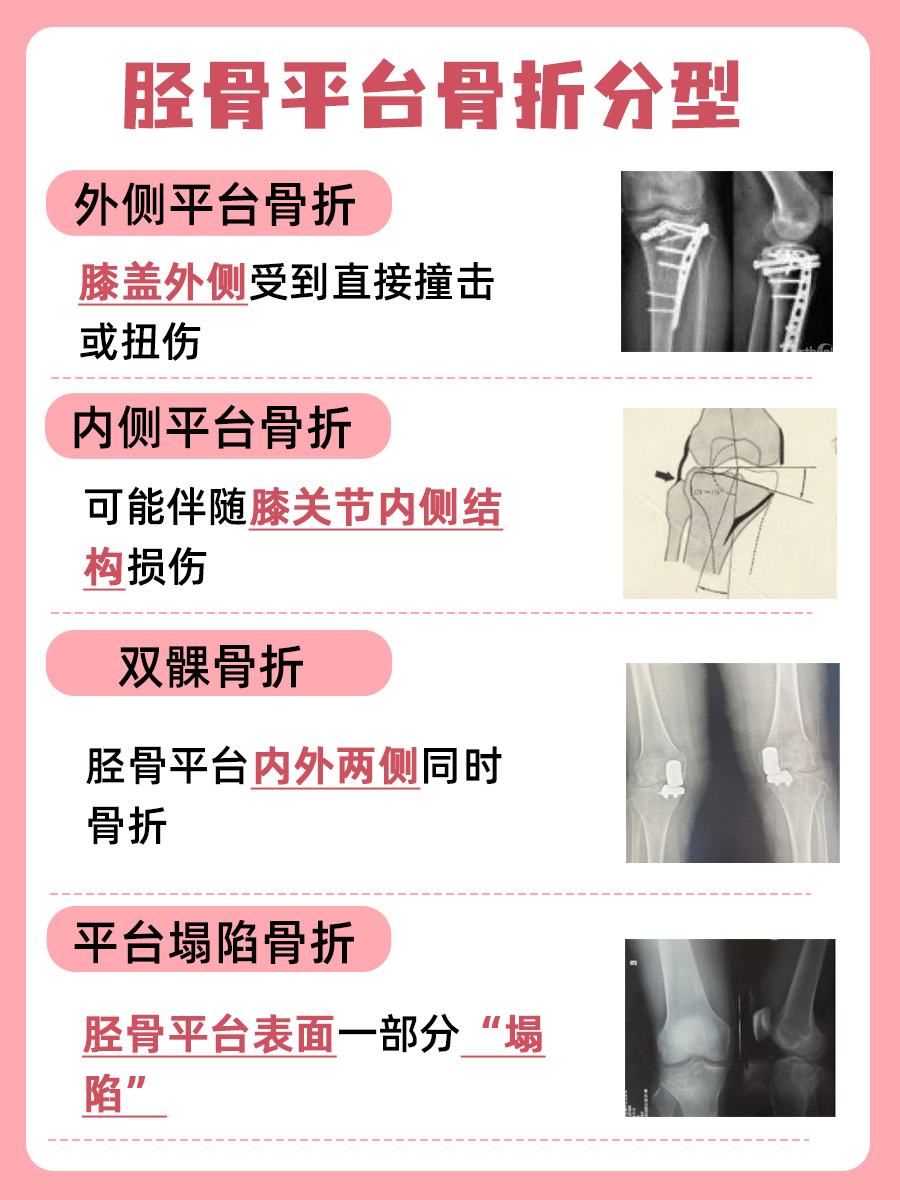 骨科医生揭秘：胫骨平台骨折分型全攻略