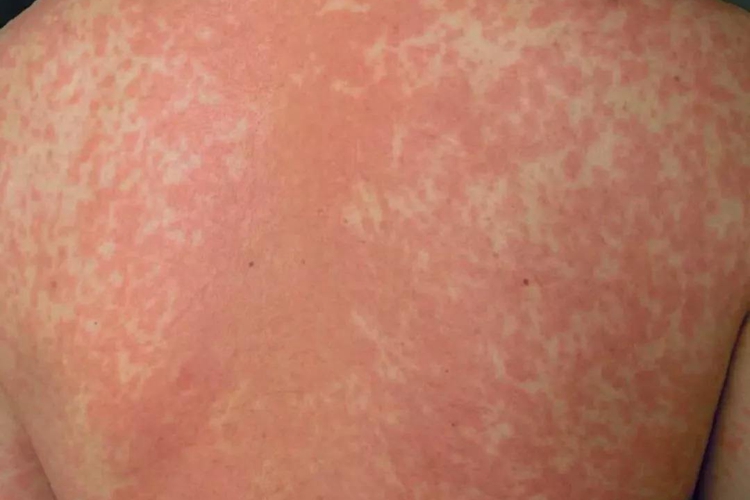 荨麻疹型药疹图