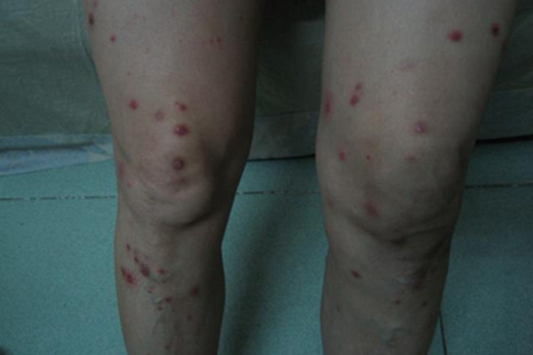 松毛虫皮炎大腿红斑图