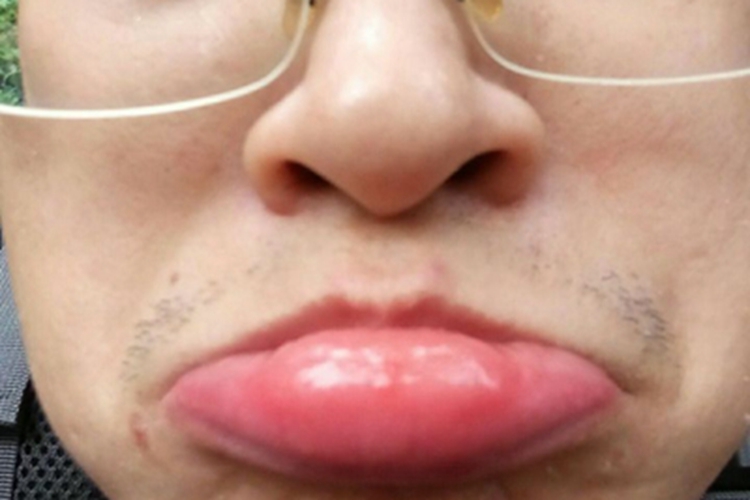 蜂蜇伤下嘴唇中间红肿图