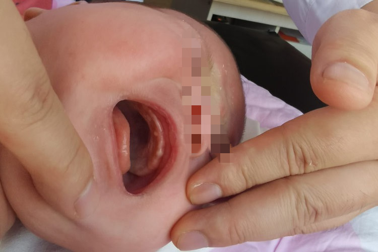 上牙龈附近马牙图