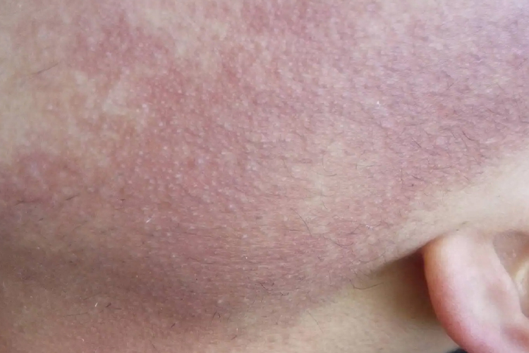 脸两侧长鸡皮疙瘩图