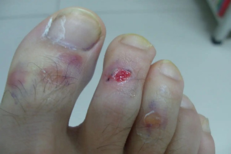 疥疮脚趾长水疱发炎化脓图