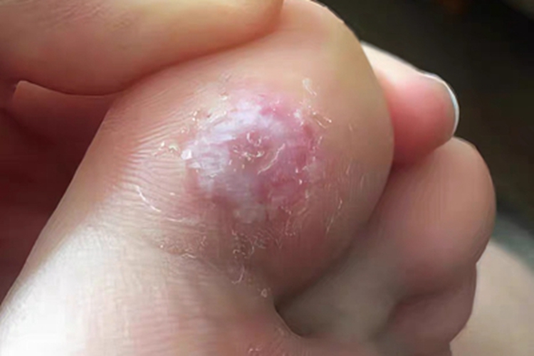 胼胝脚趾脱屑图 胼胝脚趾脱屑图