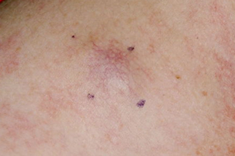 蜘蛛状毛细血管扩张症胸部血丝图