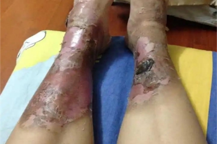 深二度烫伤腿水疱图 深二度烫伤腿水疱图