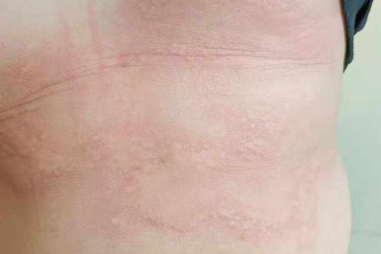 儿童荨麻疹红斑图