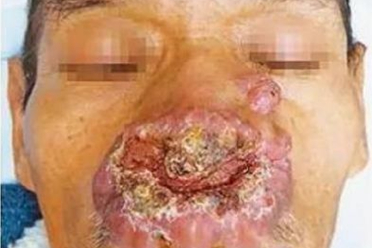 鼻硬结病结痂图 鼻硬结病结痂图