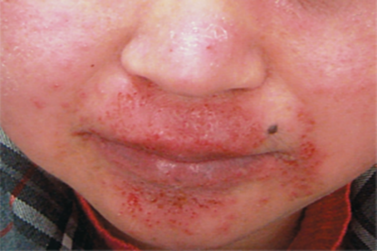 急性湿疹下巴发红起小疙瘩图