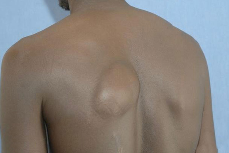 单发皮下脂肪瘤图