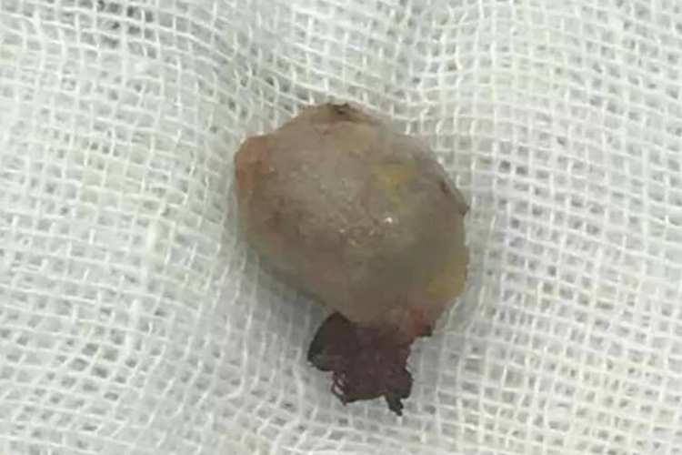 粉瘤切出来图 粉瘤切出来图