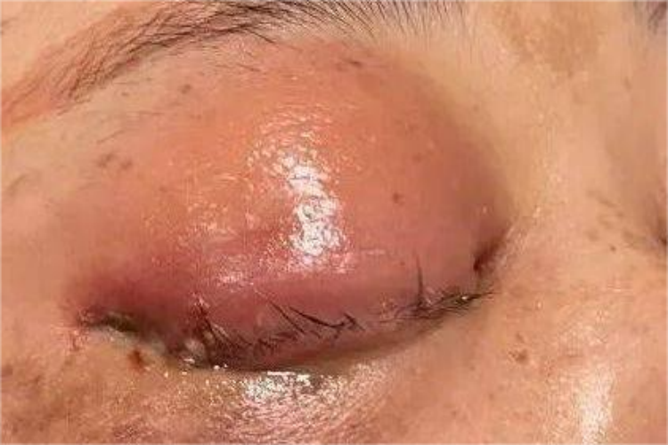 眼眶血肿眼部红肿图 眼眶血肿眼部红肿图