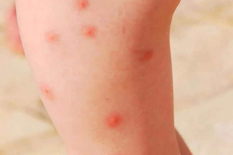 蚊子咬后真菌感染腿部长丘疹图