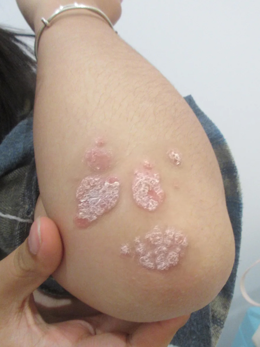 银屑病复发的10个征兆，早发现早控制！