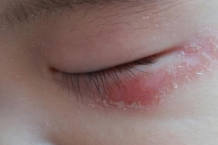 慢性湿疹眼周鳞屑图 慢性湿疹眼周鳞屑图