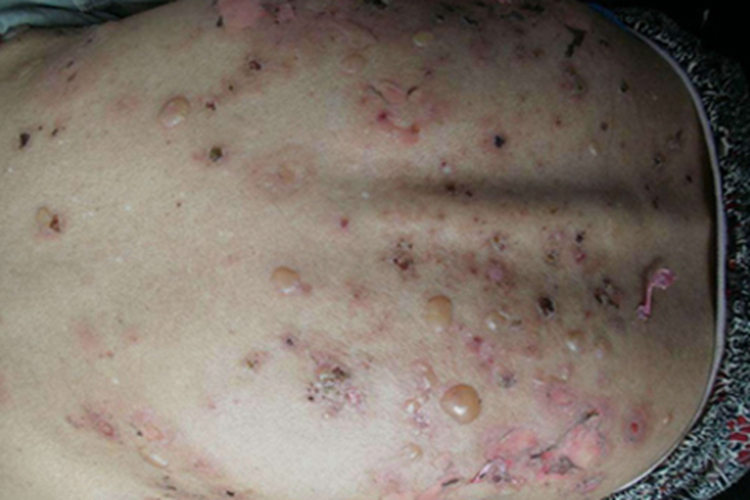 落叶型天疱疮背部症状图