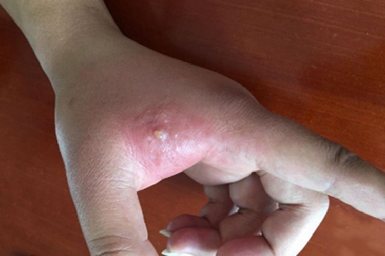 蜂蜇伤手部红斑图