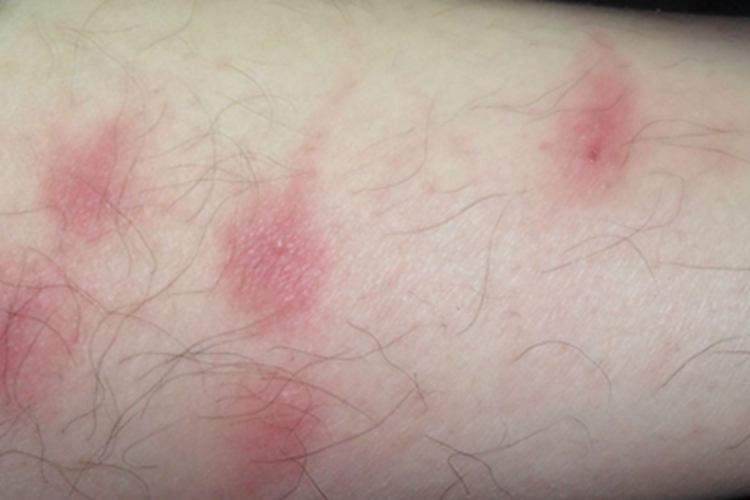 虫咬皮炎小腿小水疱图
