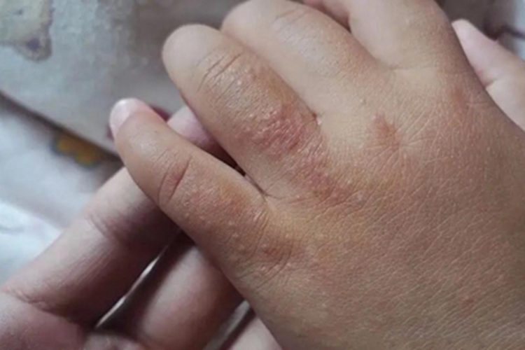 摩擦性苔藓样疹手指症状图 摩擦性苔藓样疹手指症状图