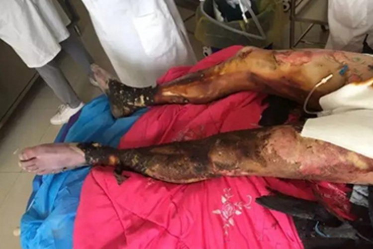 电烧伤小腿症状图 电烧伤小腿症状图