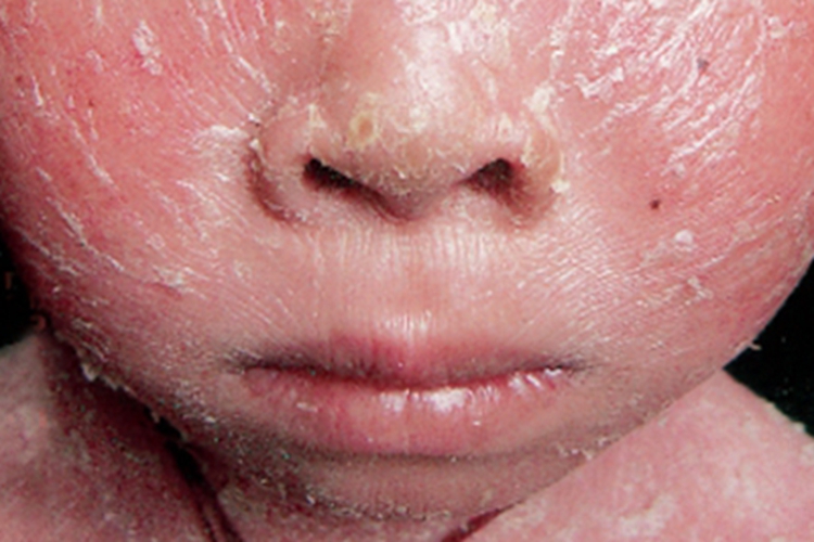 毛发红糠疹性红皮病潮红图