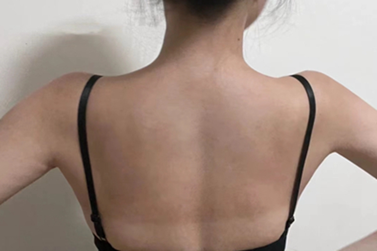 日晒伤后背变为浅褐色图