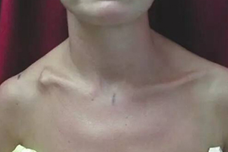 锁骨骨折畸形愈合骨短缩图