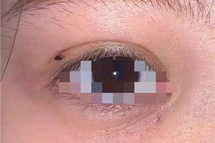 皮内痣眼睑症状图