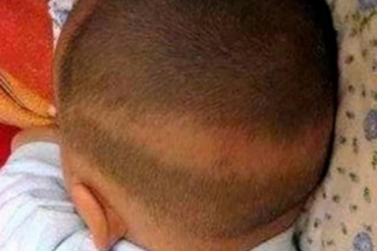 维生素D缺乏性佝偻病症状图 维生素D缺乏性佝偻病症状图