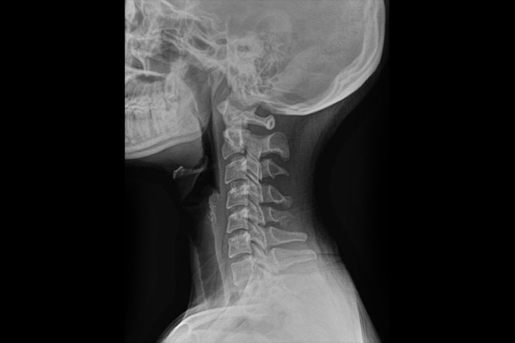 颈椎侧位片图