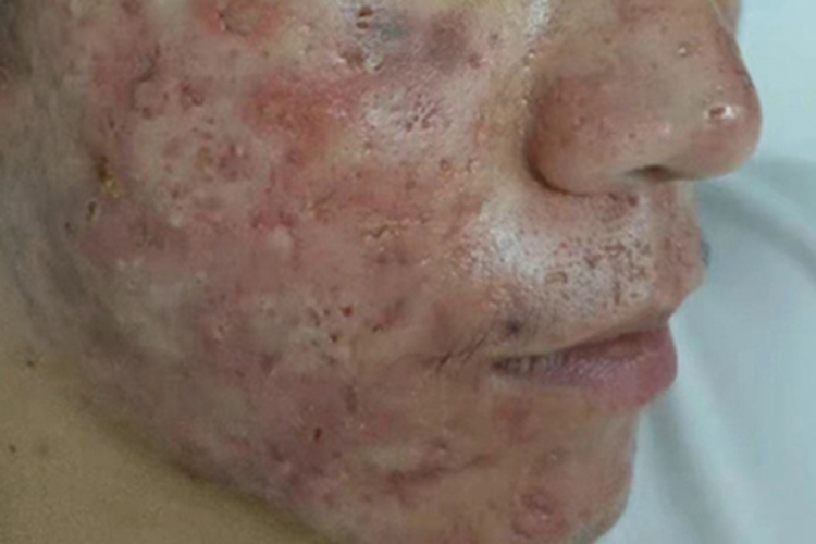 炎症后色素沉着脸上有斑块图 炎症后色素沉着脸上有斑块图