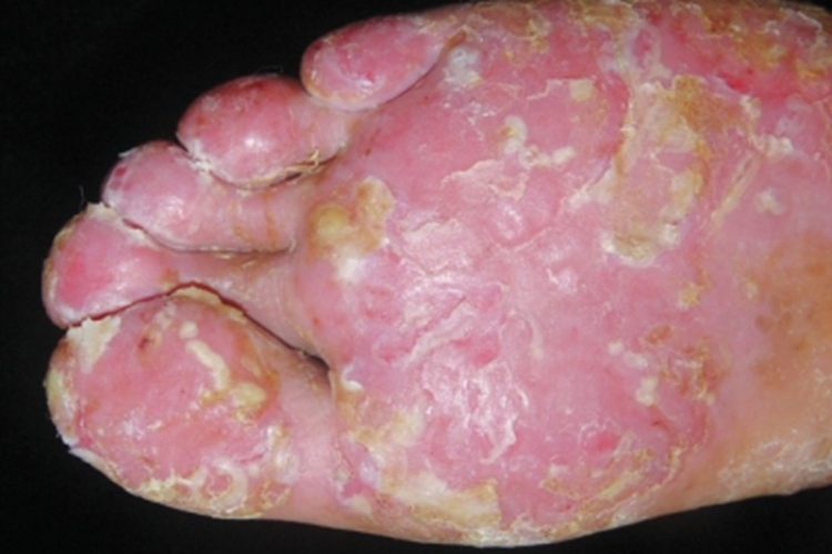 寻常型银屑病脚底糜烂脱皮图