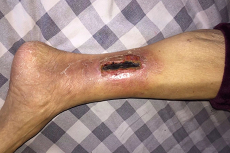 糖尿病性皮肤病小腿皮肤发黑图