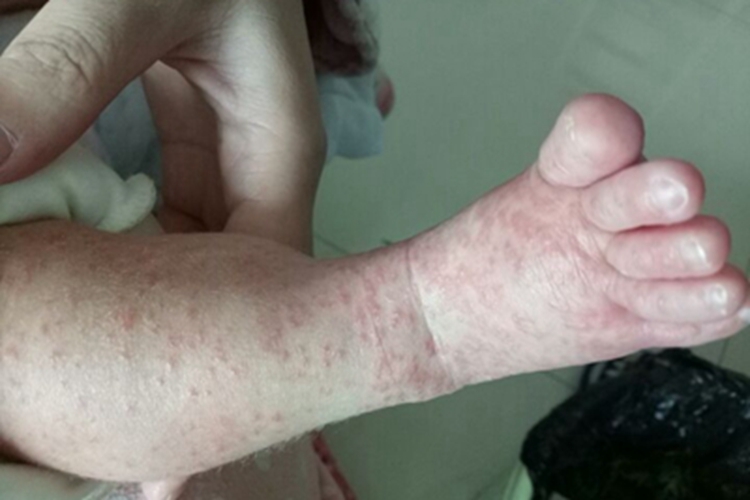 渗出型婴儿湿疹小腿出现红点图 渗出型婴儿湿疹小腿出现红点图