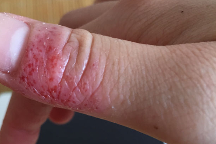 水疱型手癣糜烂图 水疱型手癣糜烂图