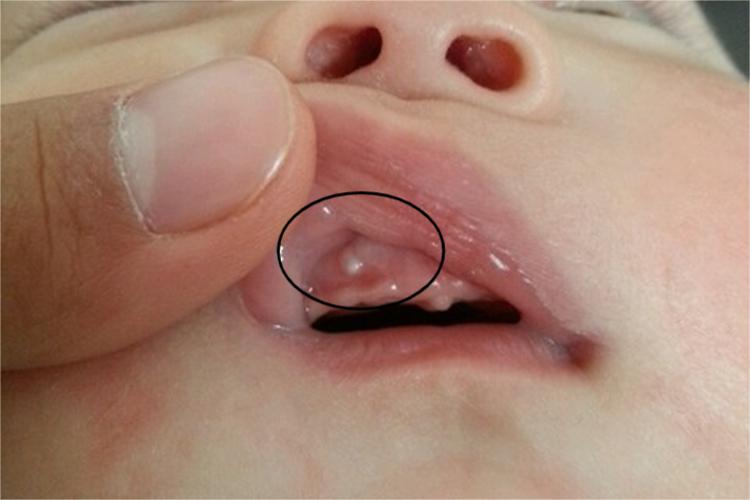 婴儿牙龈囊肿图 婴儿牙龈囊肿图