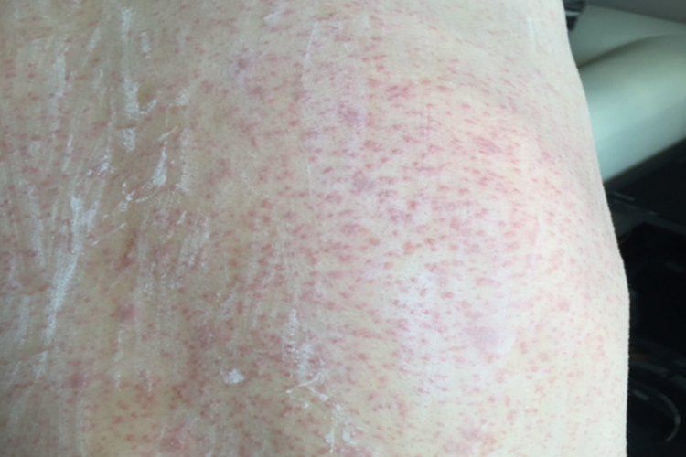 白血病后背淤血图 白血病后背淤血图