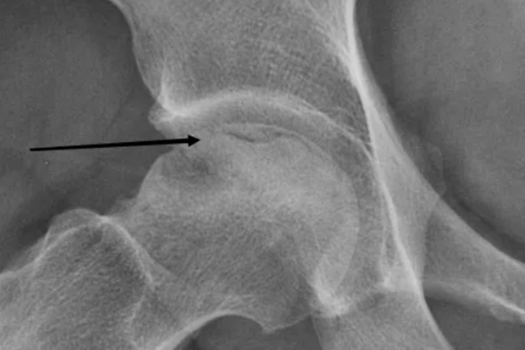 股骨头坏死新月征图 股骨头坏死新月征图