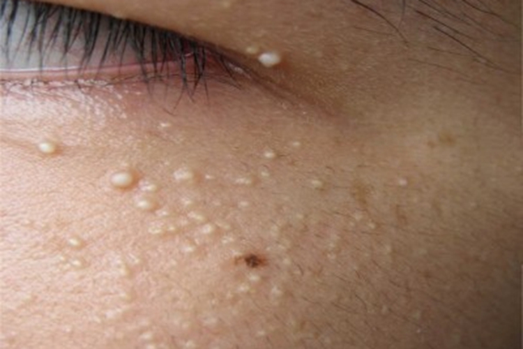 继发性粟丘疹面部丘疹图