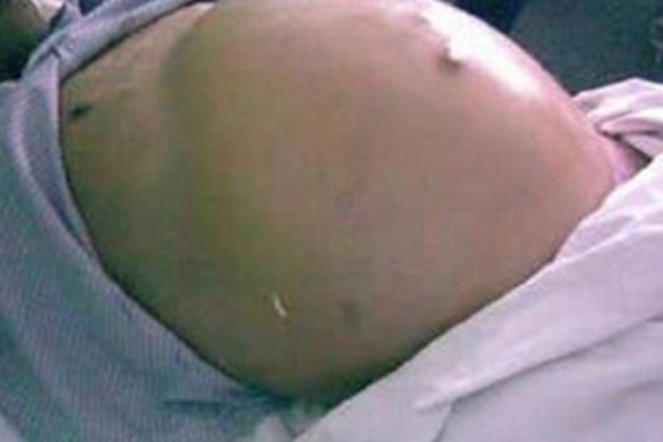 肝硬化腹部膨隆图