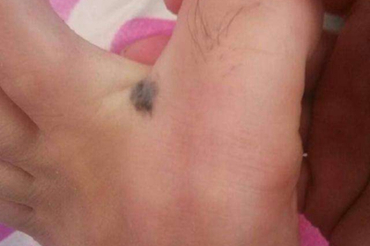 黑素细胞痣脚趾缝痣图