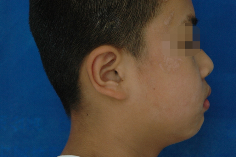 下颌发育异常轻微前突图 下颌发育异常轻微前突图