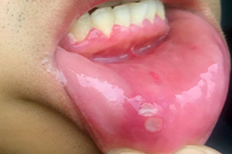 白塞病口腔初期图片