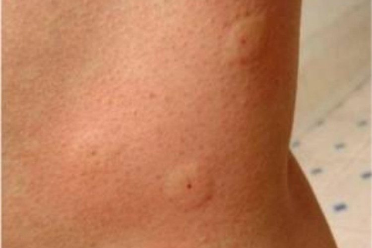 毛虫皮炎腿部风团症状图 毛虫皮炎腿部风团症状图