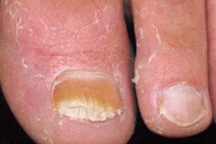 全甲损毁型甲真菌病脚趾甲增厚图