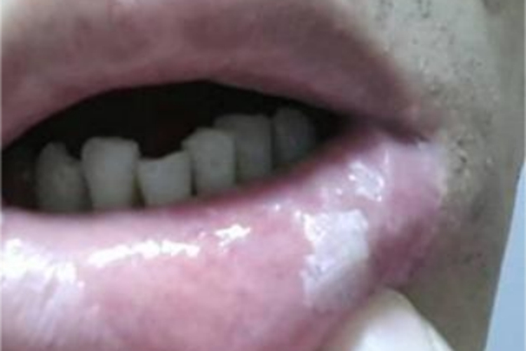 口腔白斑病嘴唇长白斑图