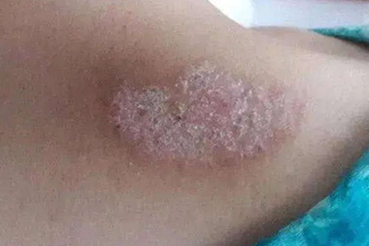 扁平苔藓样角化病脱屑图 扁平苔藓样角化病脱屑图