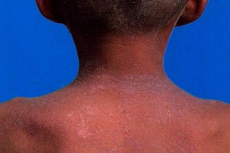 艾滋病毛发红糠疹图 艾滋病毛发红糠疹图